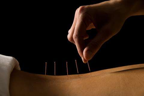 Acupuncture - Isabelle Deblois